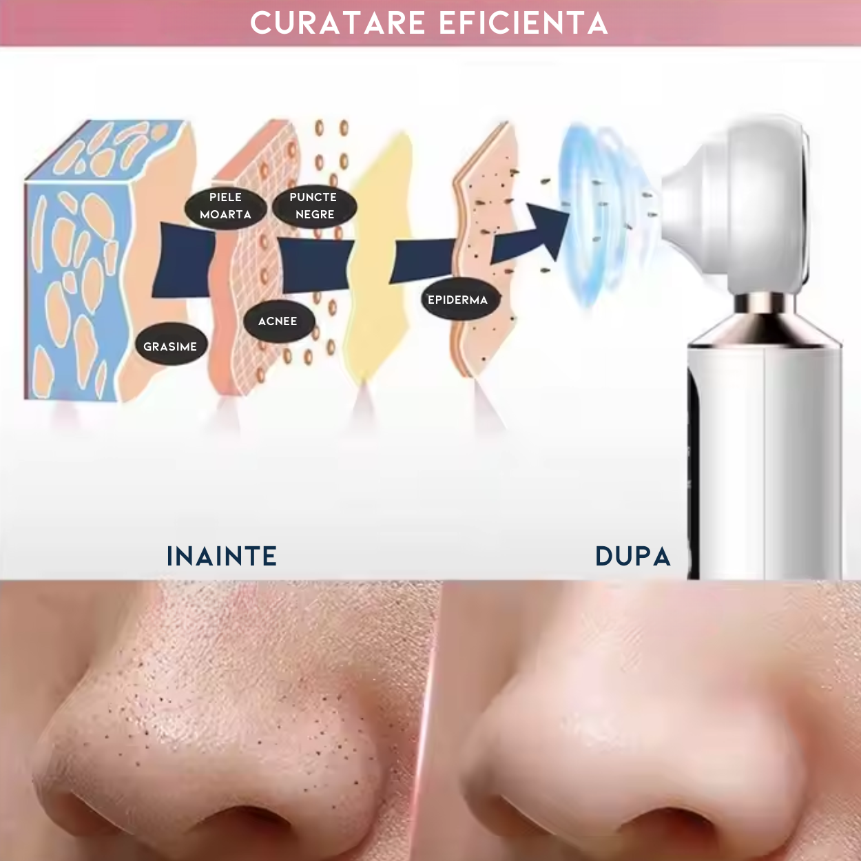 Aparat Profesional AnaStorya pentru Indepartarea Punctelor Negre cu Lupa si Lumina LED